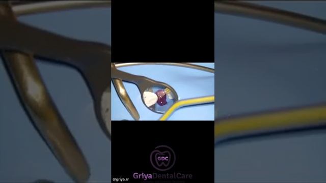 Восстановление премоляров !?? Restoration of premolars?? смотреть онлайн