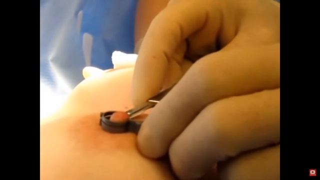 ASSI Moliver Nipple Holding Forceps смотреть онлайн