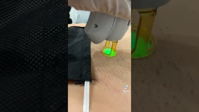 лазерная эпиляция смотреть онлайн