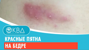 ? Красные пятна на бедре. Клинический случай №314