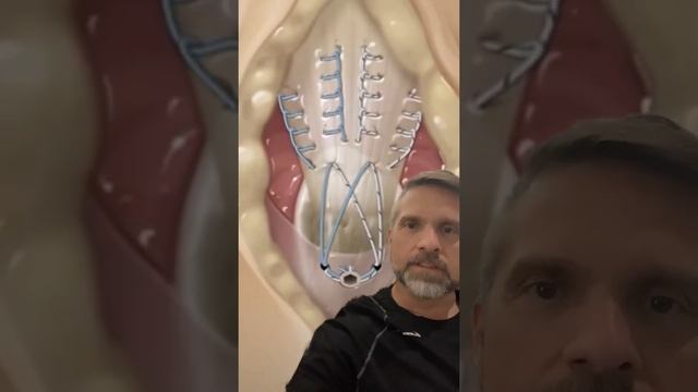 What It Looks Like When Your Tricep Tendon Snaps And How They Suture It Back In A Place￼