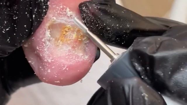 Сложная зачистка ногтей / Онихогрифоз смотреть онлайн