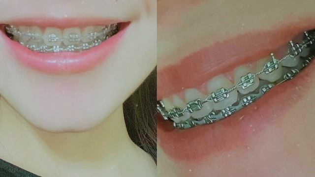 ровные,красивые зубы экстремально мощный саблиминал⚠️ by eilly☆ смотреть онлайн