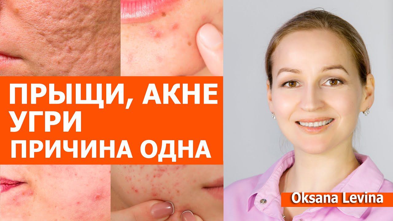 Прыщи, угри и акне все дело в еде. Как еда влияет на прыщи. смотреть онлайн