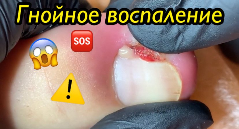 Гнойное воспаление ?⚠️???? смотреть онлайн