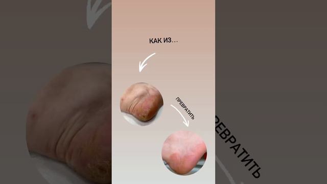 Трещины на пятках самая частая проблема на ногах. Разница между фотографиями 17 минут смотреть онлайн