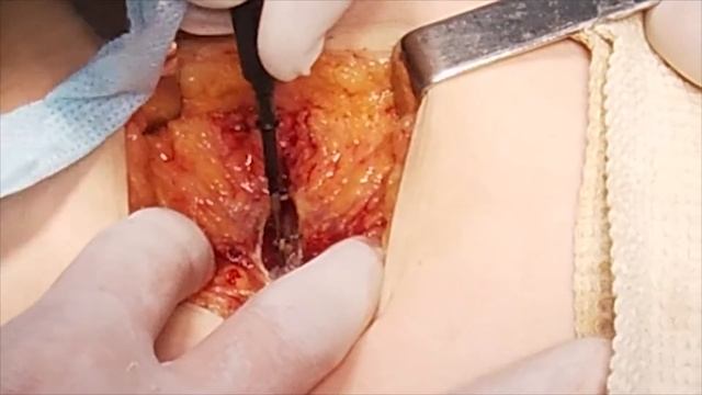 Гематома передней брюшной стенки. Гематома после кашля.Hematoma of the anterior abdominal wall