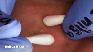 Blackheads Extractions on Christian Part 2 b