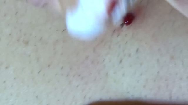 BLACKHEAD Or INGROWN HAIR?