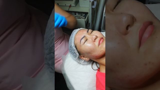 Гиалурон пен лицо смотреть онлайн