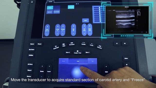 Acclarix AX8 compact ultrasound system смотреть онлайн