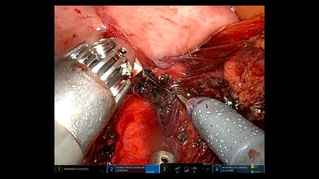 Robotic Retroperitoneal Lymph Node Dissection смотреть онлайн