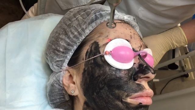 Карбоновый пилинг смотреть онлайн