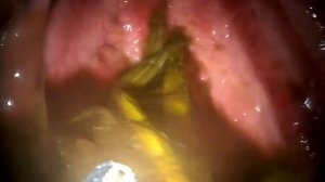 Язва желудка