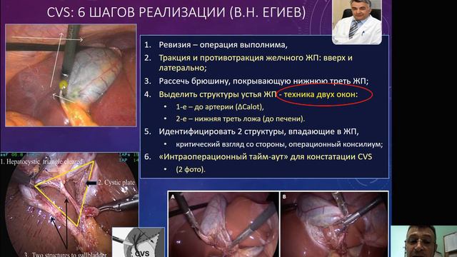 Критерии безопасной лапароскопической холецистектомии. проф. В.Д. Шейко. смотреть онлайн