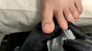 Травма ногтей.Сложный ПЕДИКЮР. Наращивание больших ногтей на ногах.