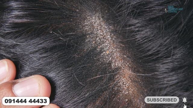 7 दिन मे Dandruff झड़ना रोके | 5 Benefits of Ketoconazole Shampoo смотреть онлайн