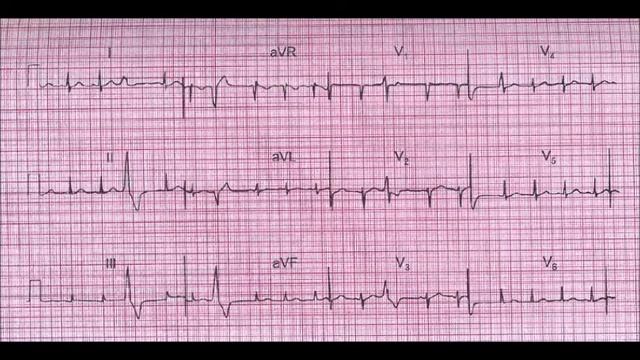 ЭКГ номер 1 - заключение, клиническая интерпретация и что делать смотреть онлайн