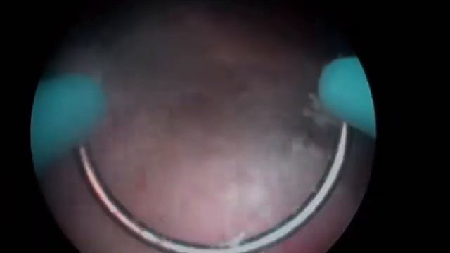 ТУР (электрорезекция) лейкоплакии мочевого пузыря смотреть онлайн