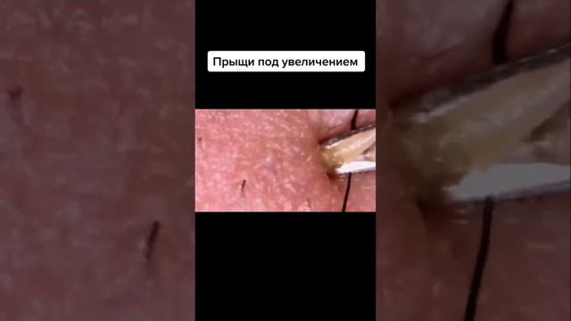 Самое залипательное видео давить прыщи Черные точки смотреть онлайн