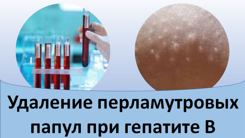 Удаление перламутровых папул при гепатите В смотреть онлайн