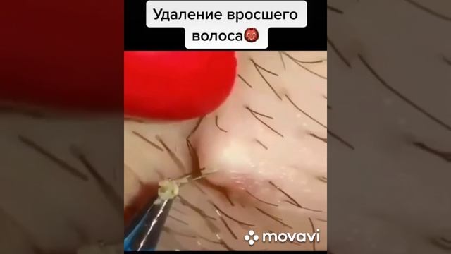 УДАЛЕНИЕ ОЧЕНЬ ДЛИННОГО ВРОСШЕГО ВОЛОСА|REMOVAL OF VERY LONG INDUSTRIAL HAIR смотреть онлайн