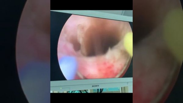 Киста простаты cyst prostate