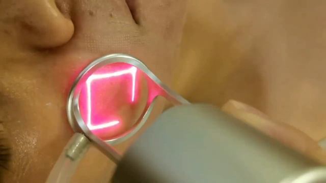 Do u have acne scars (acne pits, acne marks), repair of superficial scars, large pores 974-5515171 смотреть онлайн