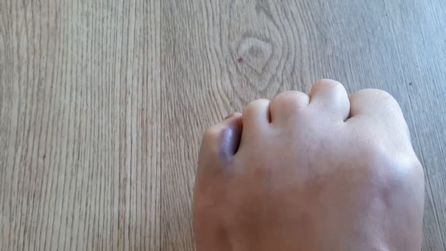 Как отличить ПЕРЕЛОМ МИЗИНЦА ОТ УШИБА смотреть онлайн