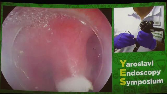 23Live Rehan Haidry Дивертикул Ценкера Эндоскопическая крикофарингомиотомия SB Knife смотреть онлайн