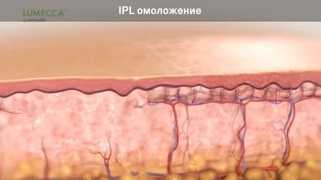 Фотоомоложение IPL: лечение пигментаци и купероза. смотреть онлайн