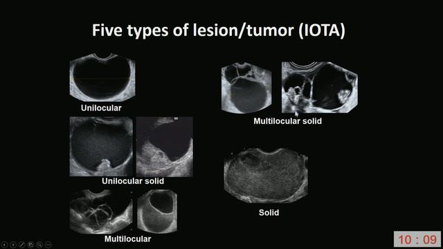 How to describe an adnexal mass IOTA terms and definitions ISUOG 2018 смотреть онлайн