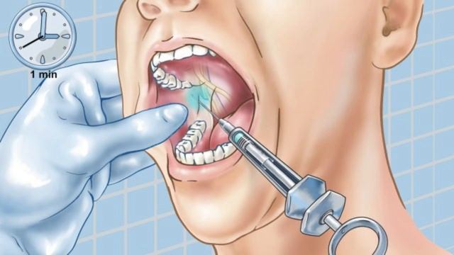 Standard Inferior Alveolar Nerve Block смотреть онлайн