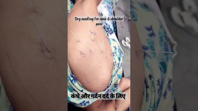 neck pain shoulder pain #dryneedling смотреть онлайн