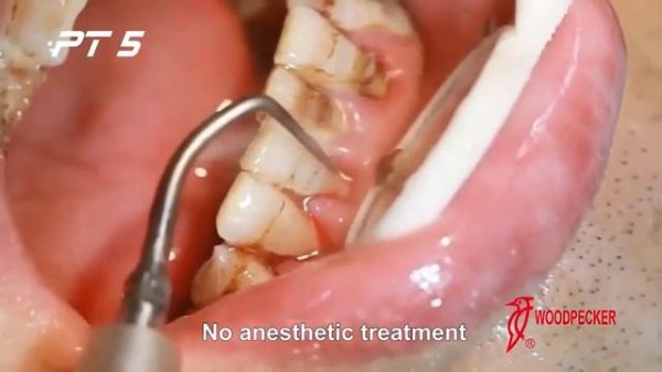 PT5 Master LED DTE Woodpecker Скалер ультразвуковой | Обзор