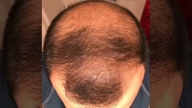 6 Months Using minoxidil - Rogaine 5% Before & After Results