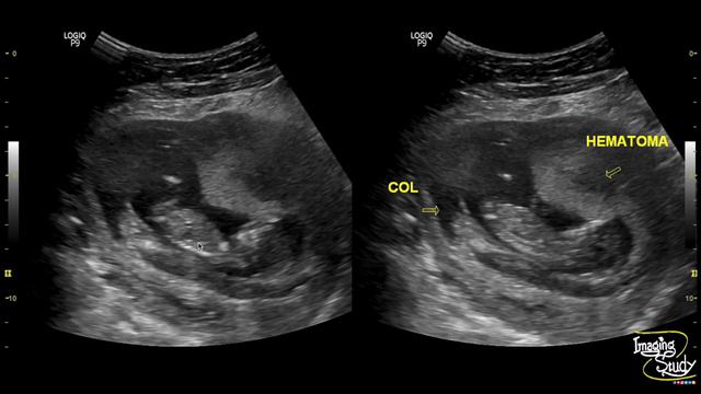 Subchorionic Hemorrhage || Ultrasound || Case 193 смотреть онлайн