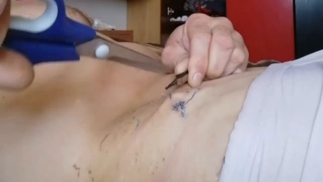АППЕНДИЦИТ швы смотреть онлайн