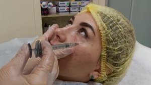 Инъекционная косметология. Заполнение носослезной борозды.