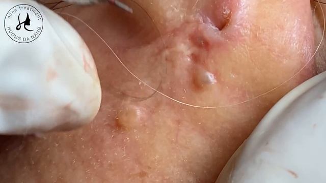 #257 | Huong Da Nang - Super Big Acne Part 2 смотреть онлайн