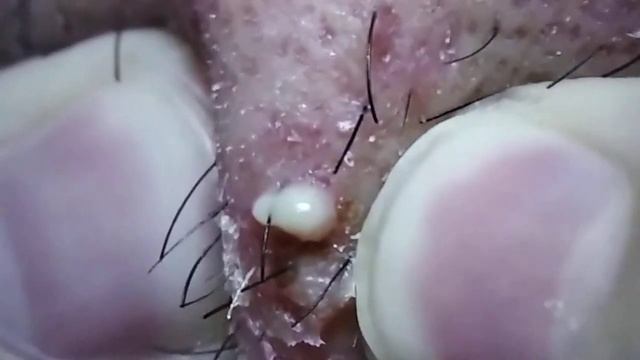 ✪ Blackhead Extraction | Acne Treatment | Pimples Popping #2 смотреть онлайн