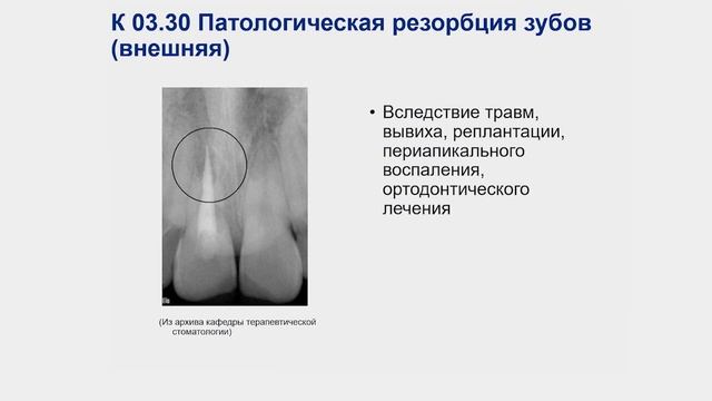 Некариозные поражения твёрдых тканей зубов. Часть 2