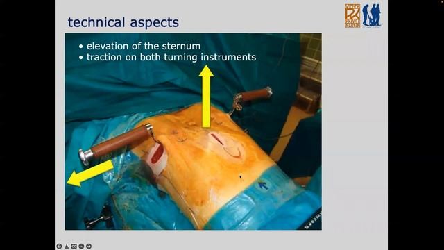 Wiener Privatklinik - Pectus Excavatum Correction By Prof. Dr. Alexander Rokitansky