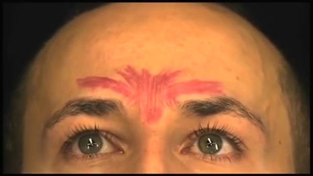 Демонстрация процедуры введения препарат "Ботокс" в область межбровья смотреть онлайн