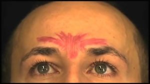 Демонстрация процедуры введения препарат "Ботокс" в область межбровья