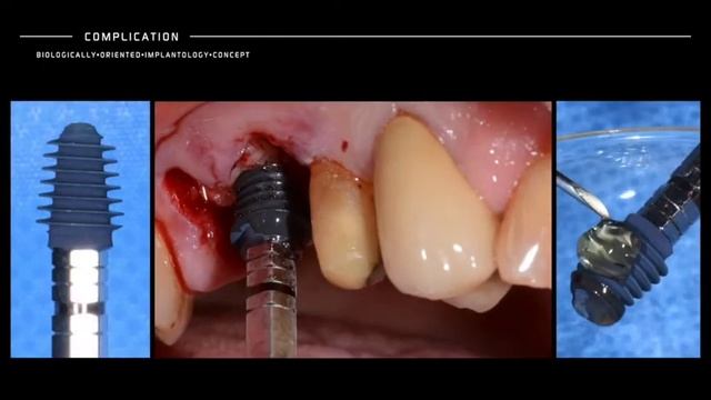 IMMEDIATE IMPLANT PLACEMENT AND ATRAUMATIC SINUS LIFT смотреть онлайн