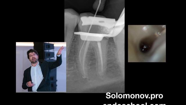 Разбор клинического случая: Сломанный инструмент смотреть онлайн