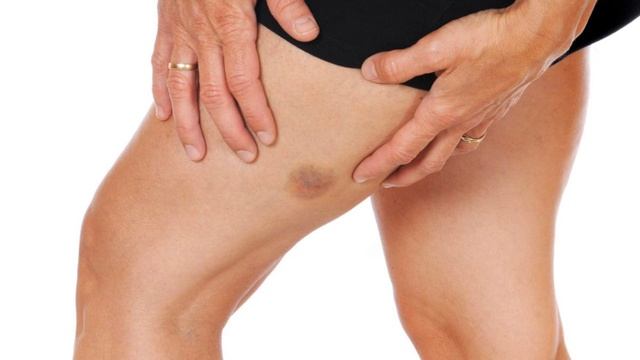 Почему появляются синяки на теле?