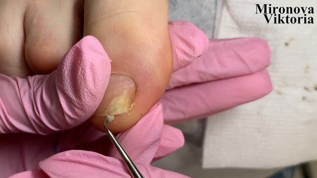 Онихолизис ? Вросший ноготь / Установка тампонады смотреть онлайн