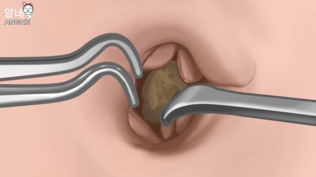 ASMR animation Removing Huge Navel Stone | Real sound | Tingle! смотреть онлайн